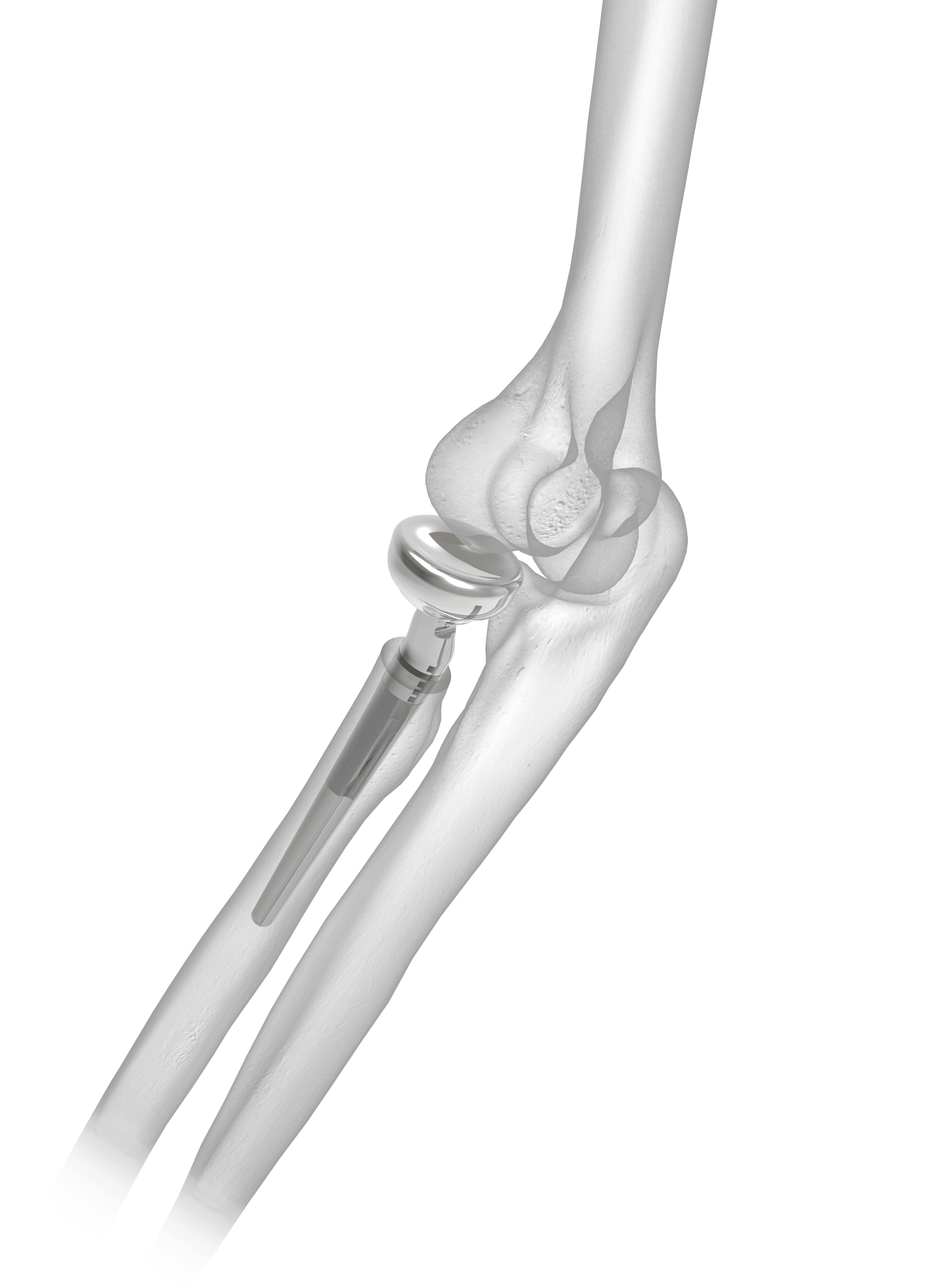 ARH Long Stem On Bone - With Laser Markings