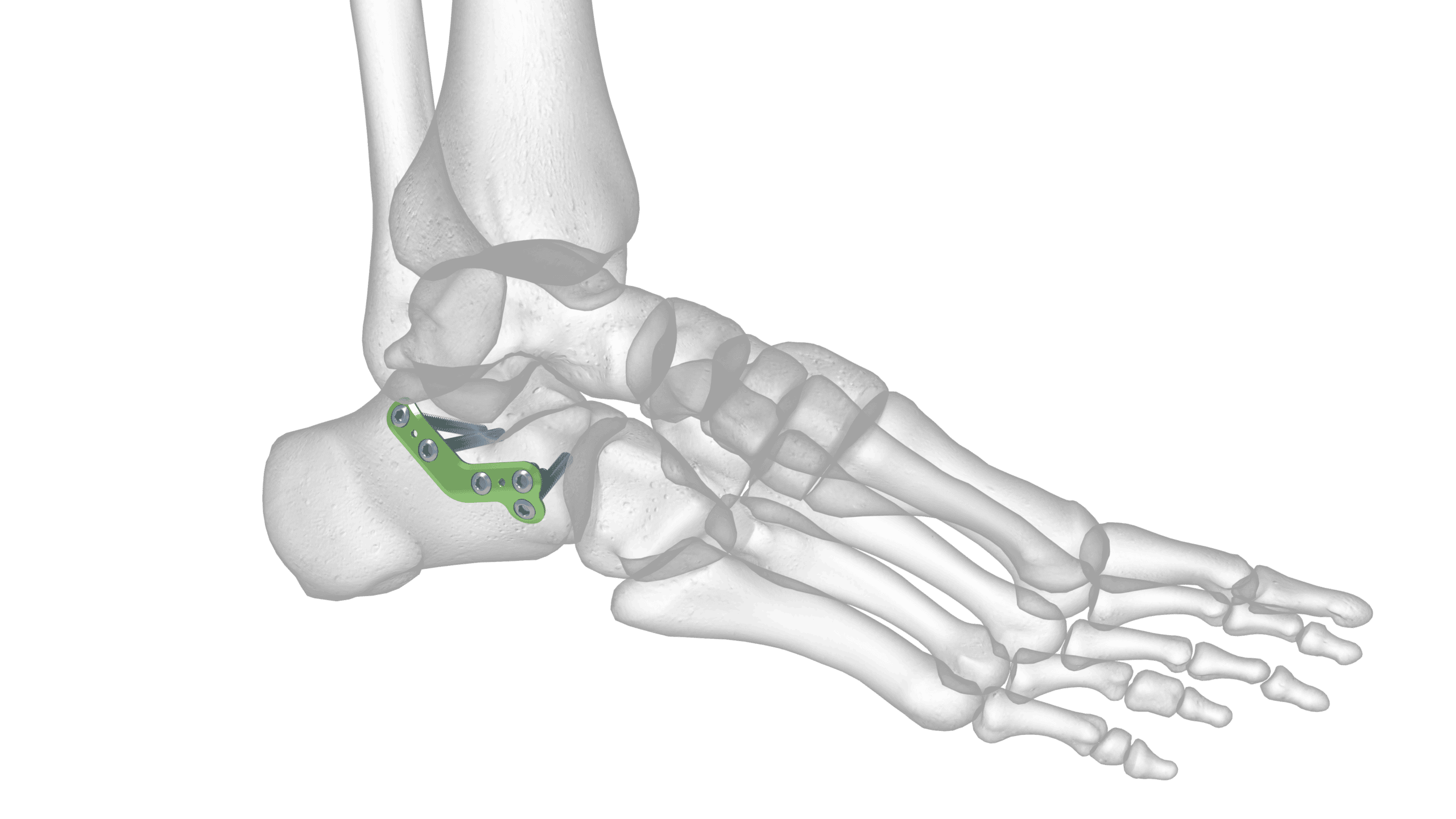 Foot and Ankle - Calcaneal Plating System - Anterior Process Plate Solo
