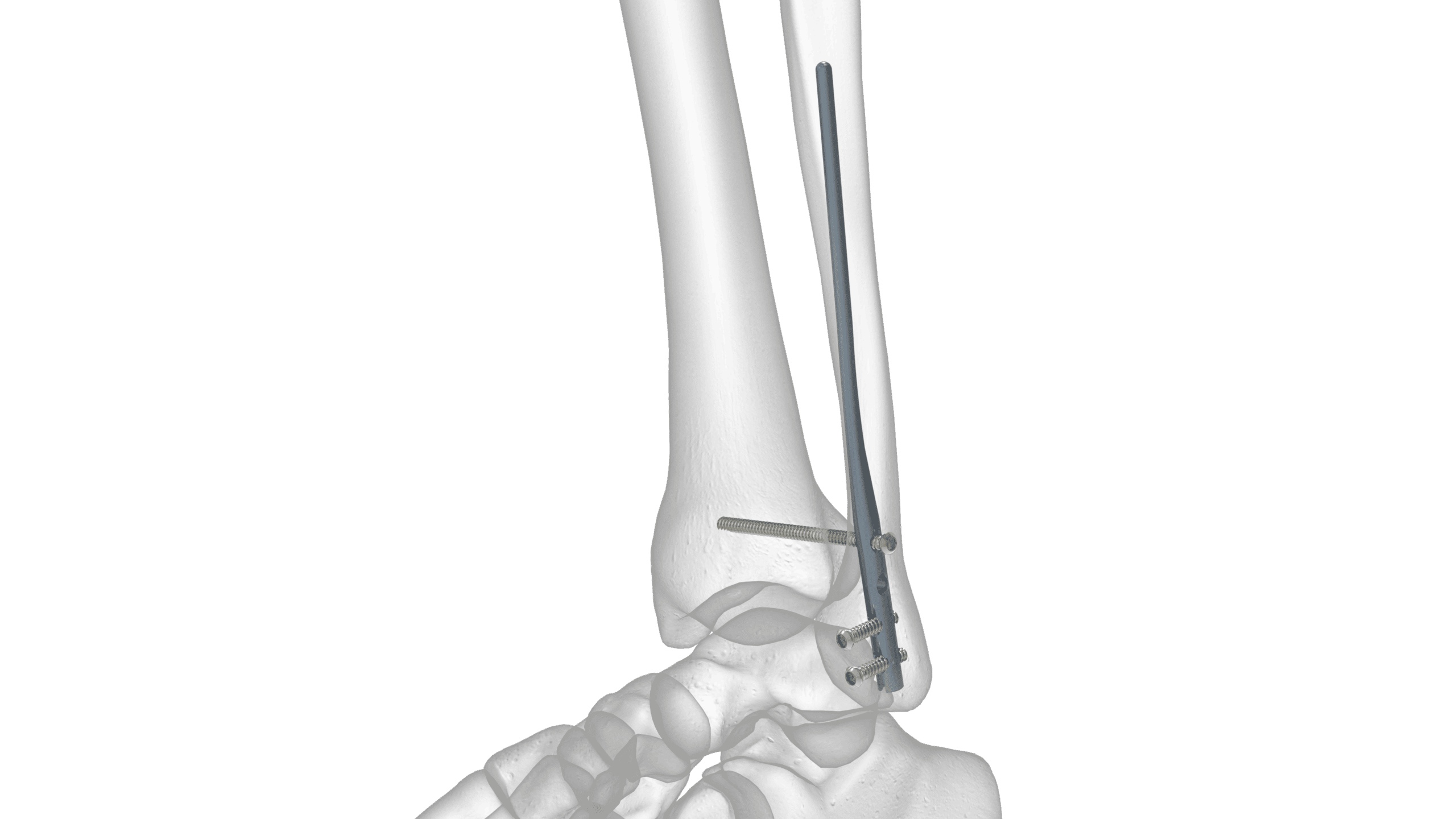 Foot and Ankle - Fibula Rod System Solo