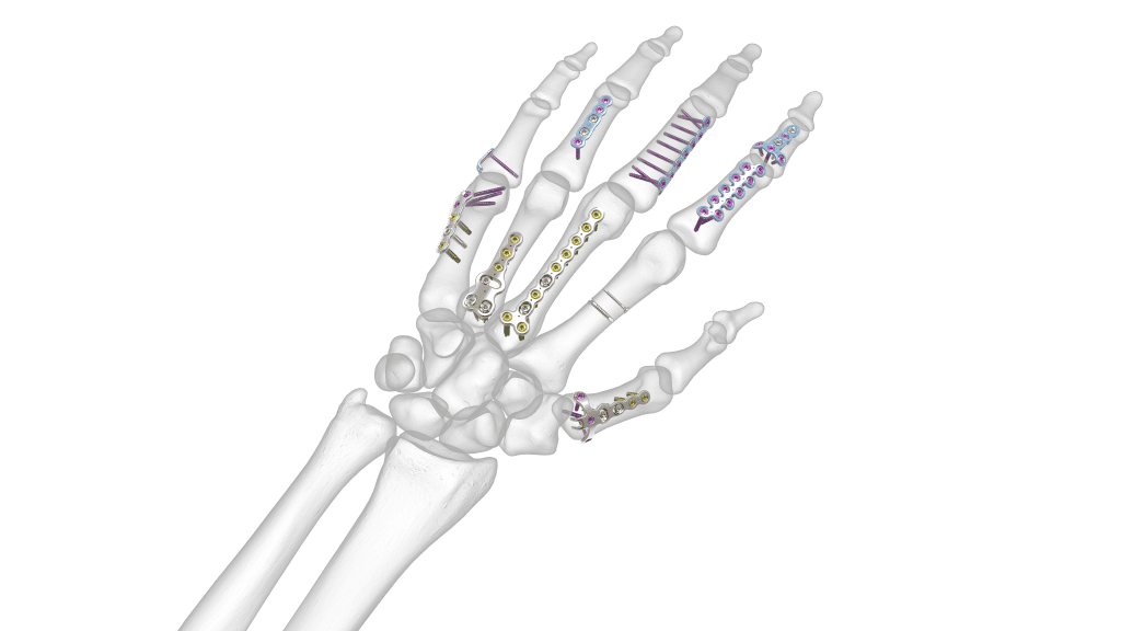Hand Fracture system