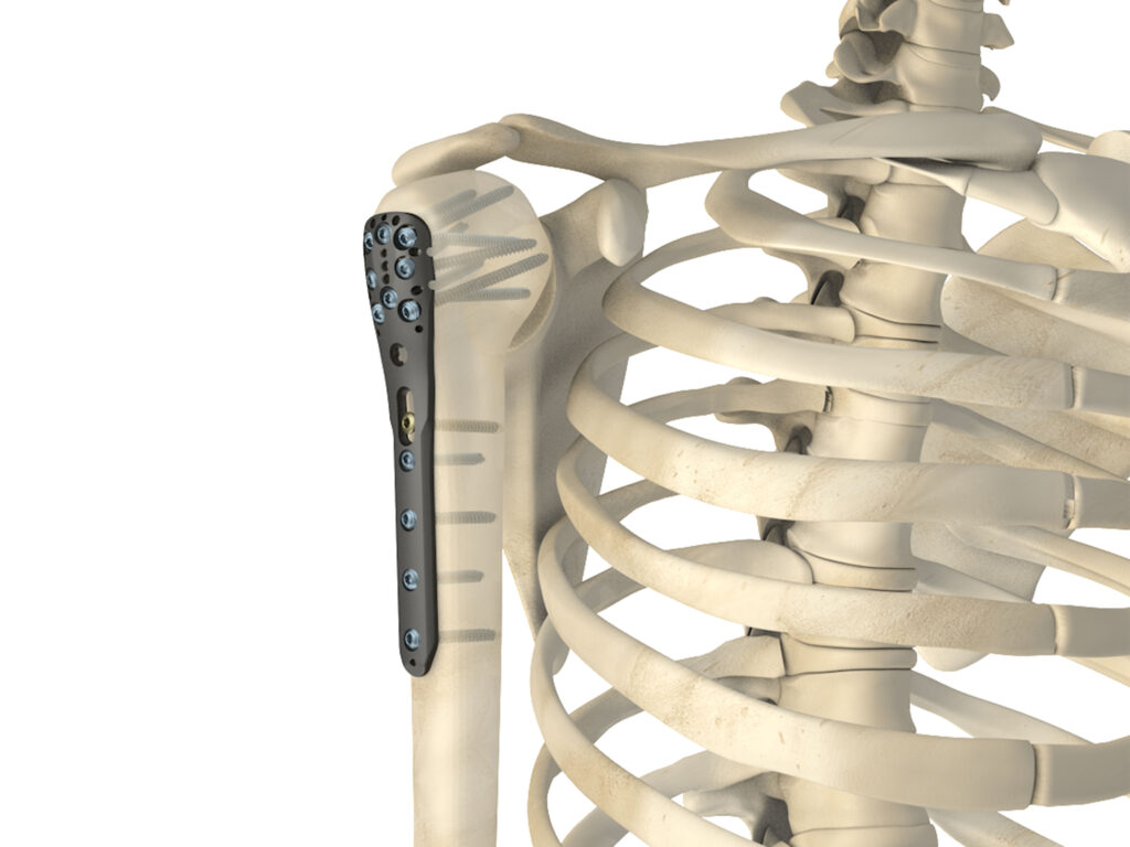 Proximal Humerus Plate Bemedico